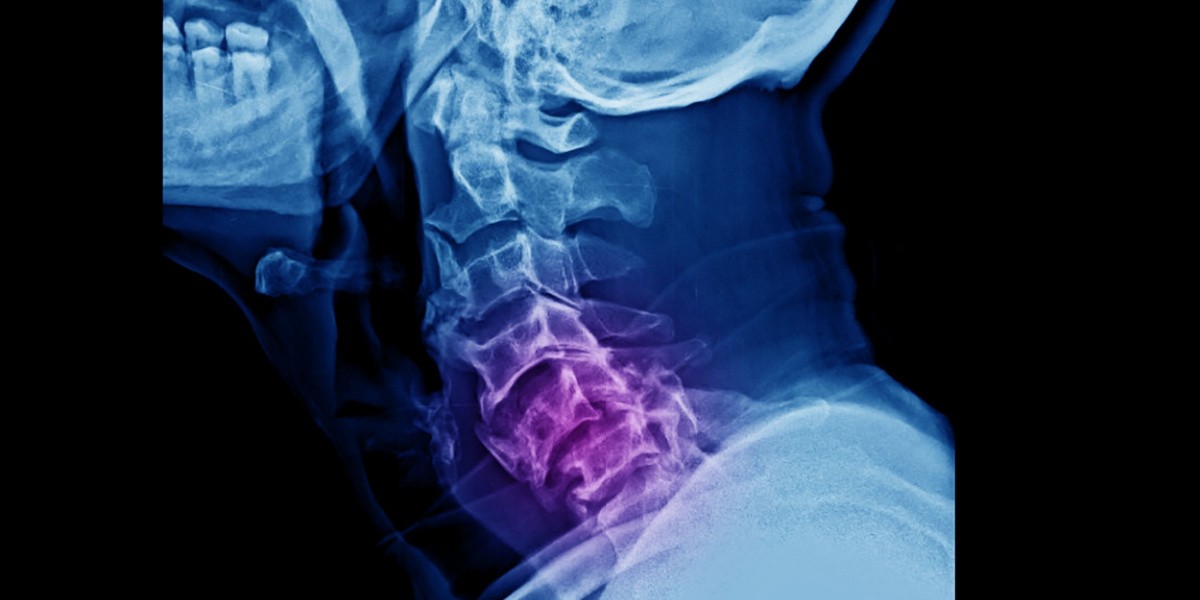 Esguince Cervical ¿a Qué Se Debe 6042