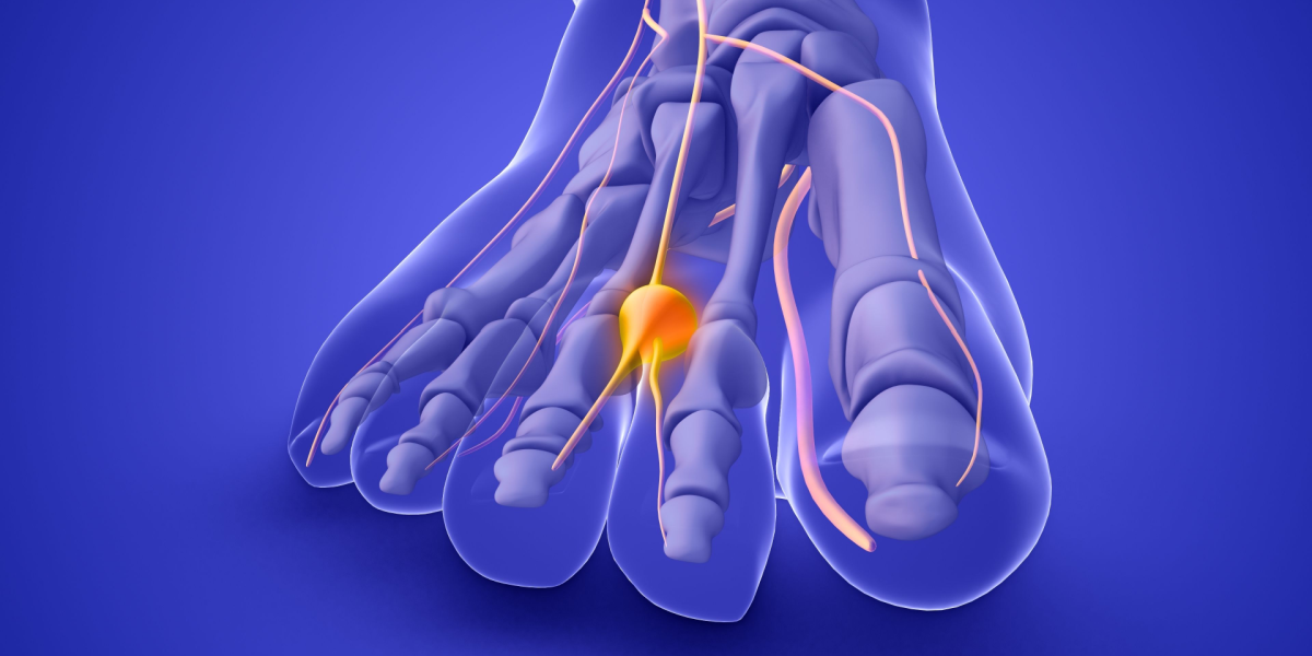 Neuroma de Morton: efectos y tratamiento