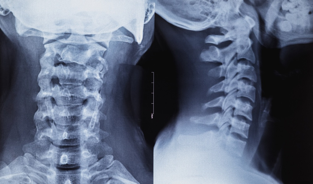 artrosis cervical